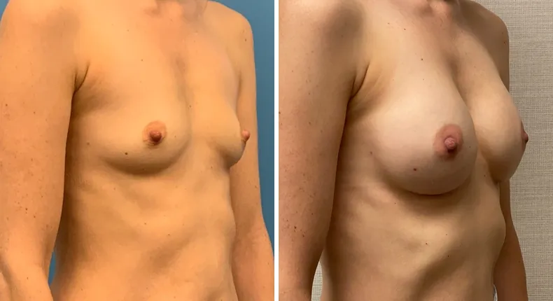 Before and after breast augmentation: woman's breasts at a right angle