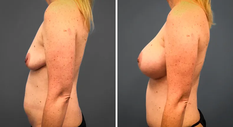 Before and after breast augmentation: patient's breasts