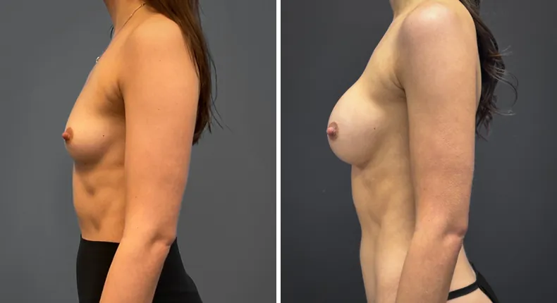 Before and after breast augmentation: patient's breasts in left profile