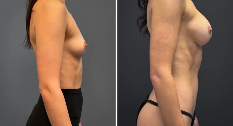 Before and after breast augmentation: patient's breasts in right profile
