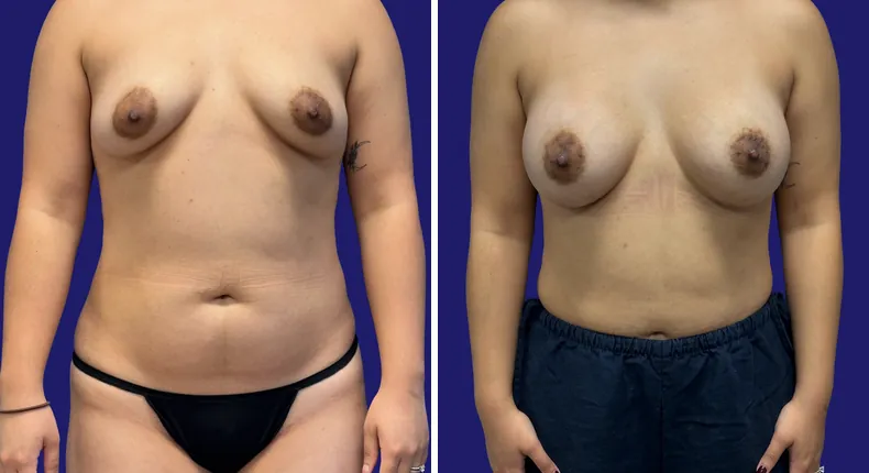 Before and after breast augmentation: woman's breasts from the front