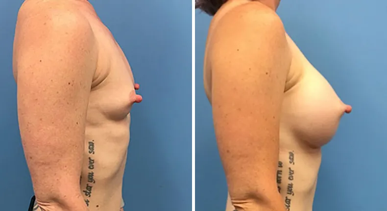 Before and after breast augmentation: woman's breasts from the right side