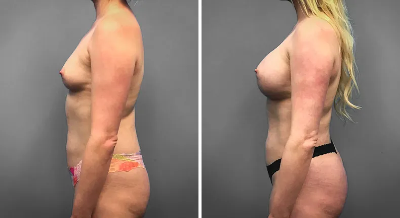 Before and after breast augmentation: patient's breasts