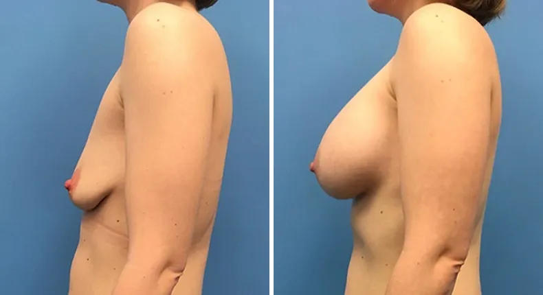 Before and after breast augmentation: patient's breasts from the left side