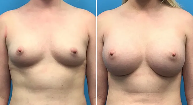 Before and after breast augmentation: woman's breasts from the front