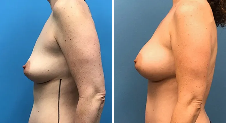 Before and after breast augmentation: woman's breasts from the left side