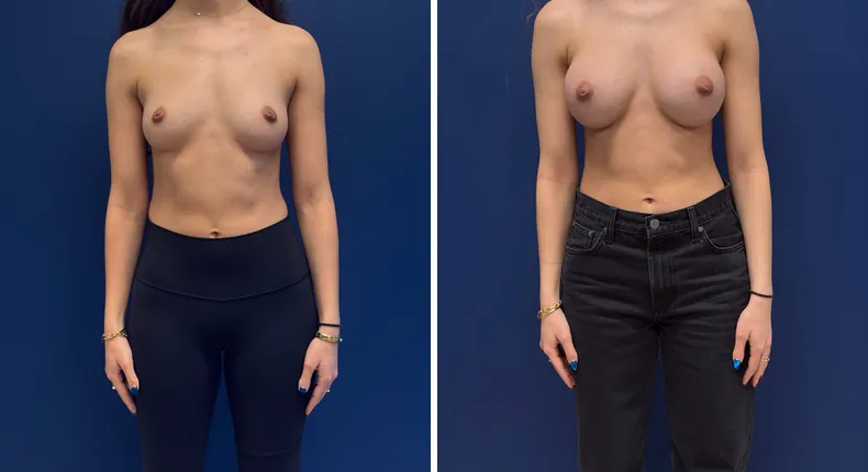 Before and after breast augmentation: patient's breasts, with preserve breast augmentation