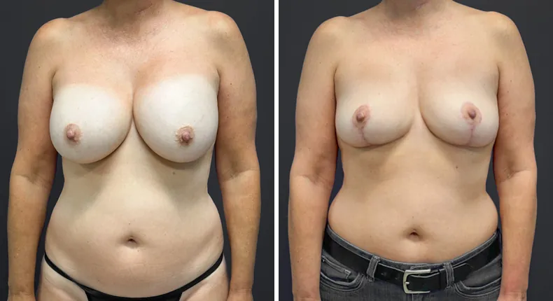 Before and after breast lift: patient's breasts from the front