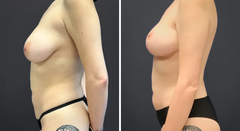 Before and after breast lift: patient's breasts from the left side