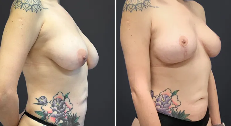 Before and after breast lift: patient's breasts at a right angle