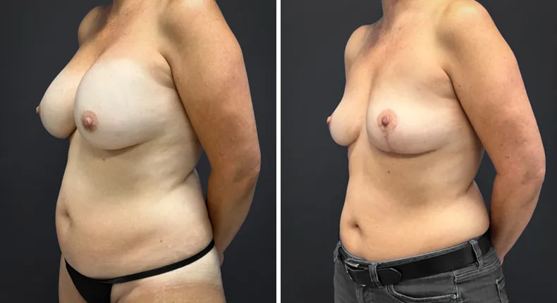 Before and after breast lift: patient's breasts at a left angle