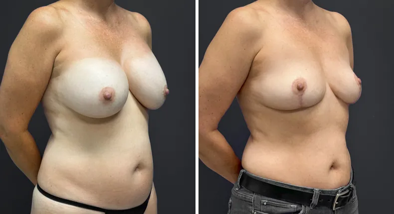 Before and after breast lift: patient's breasts at a right angle