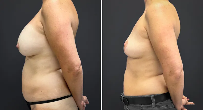 Before and after breast lift: patient's breasts from the left side