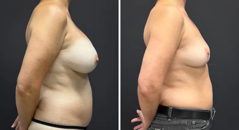Before and after breast lift: patient's breasts from the right side