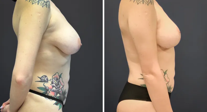 Before and after breast lift: patient's breasts from the right side