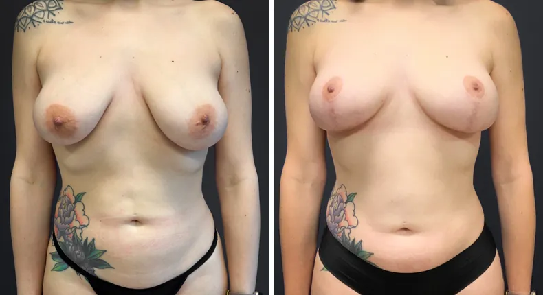 Before and after breast lift: patient's breasts from the front