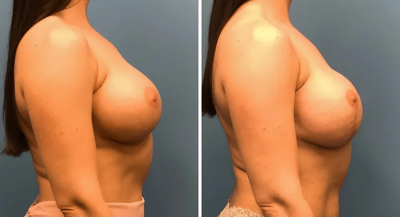 Before and after breast reconstruction: patient's breasts from the right side