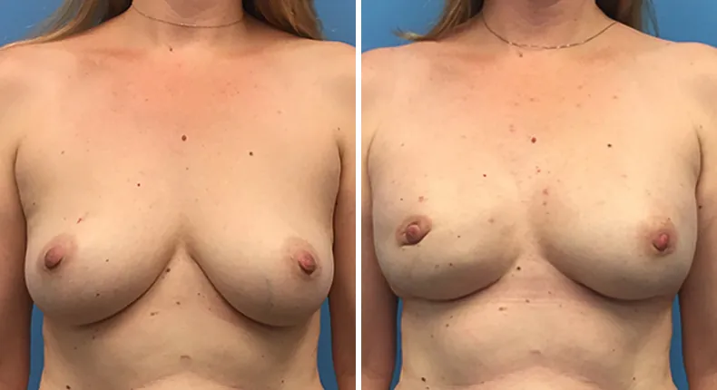Before and after breast reconstruction: woman's breasts from the front