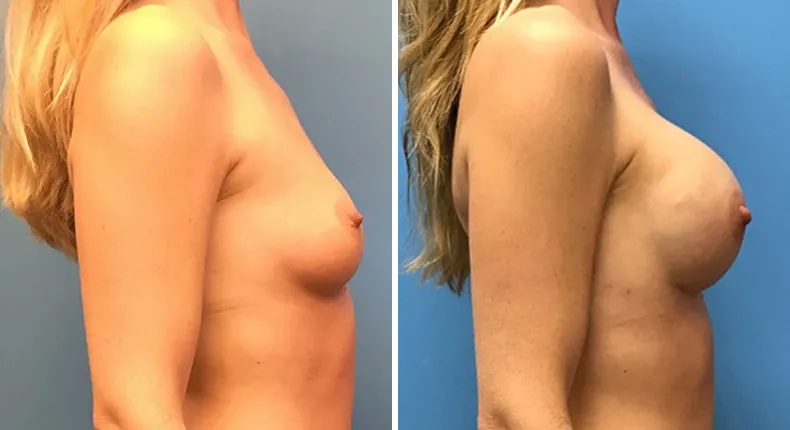 Before and after breast reconstruction: woman's breasts from the right side