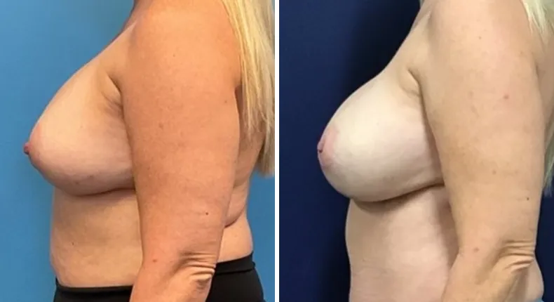 Before and after breast reconstruction: patient's breasts from the left side