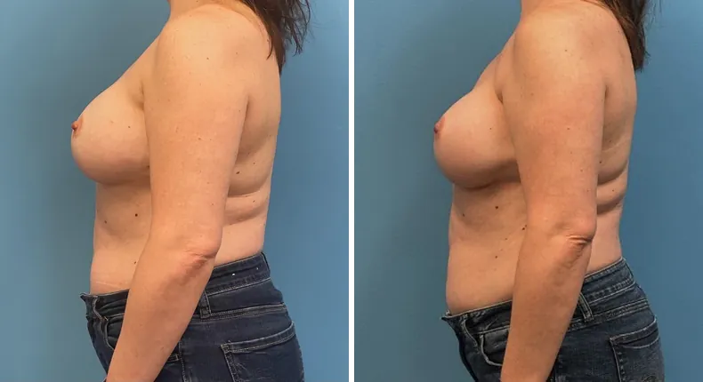 Before and after breast reconstruction: patient's breasts from the left side