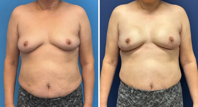 Before and after breast reconstruction: patient's breasts