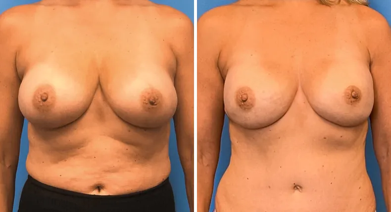 Before and after breast reconstruction: patient's breasts from the front