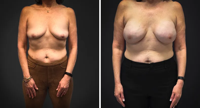 Before and after breast reconstruction: man's breasts from the front