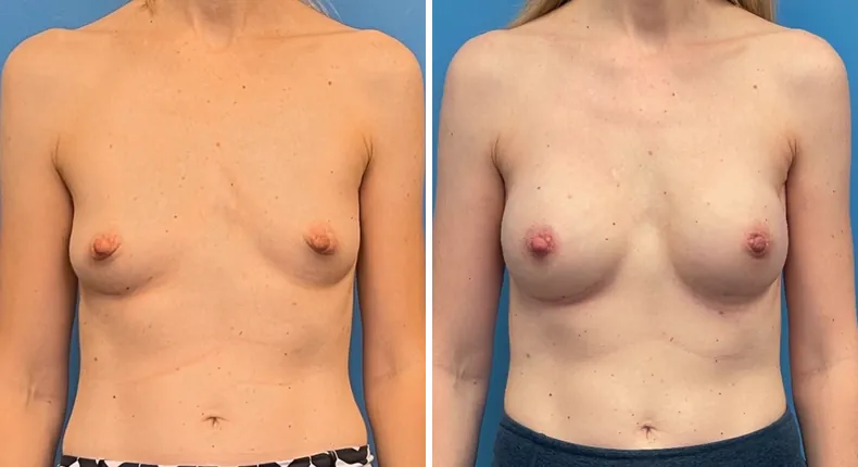 Before and after breast reconstruction: patient's breasts