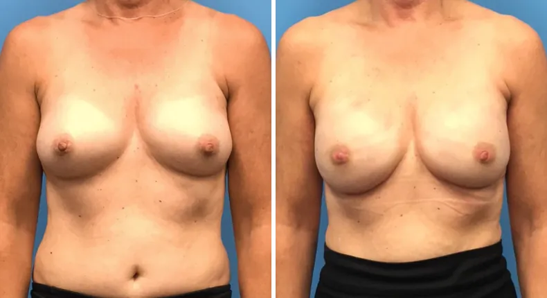 Before and after breast reconstruction: woman's breasts