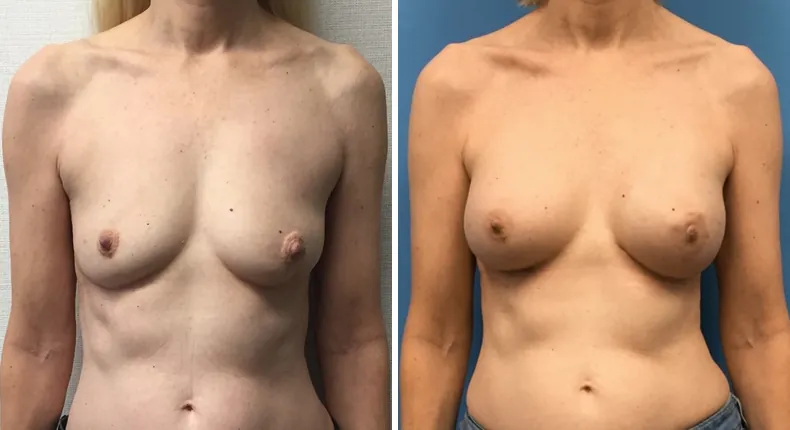 Before and after breast reconstruction: patient's breasts