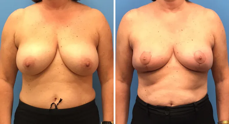 Before and after breast reconstruction: patient's breasts