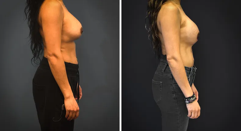Before and after breast reconstruction: patient's breasts from the right side