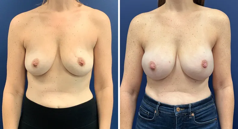 Before and after breast reconstruction: patient's breasts from the front