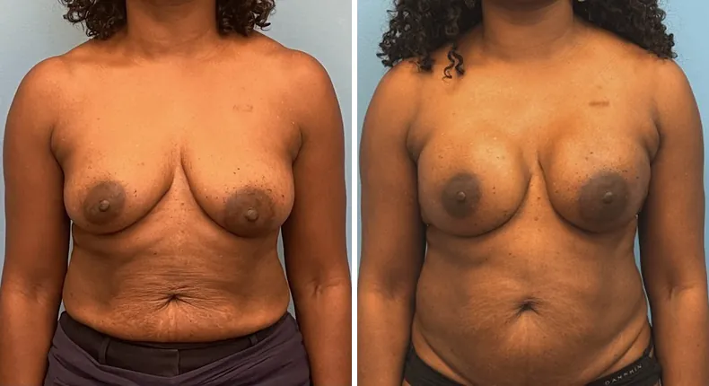 Before and after breast reconstruction: patient's breasts from the front