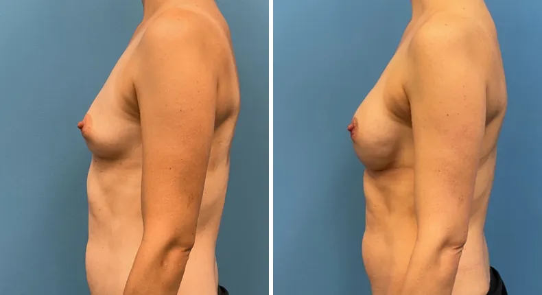 Before and after breast reconstruction: patient's breasts from the left side