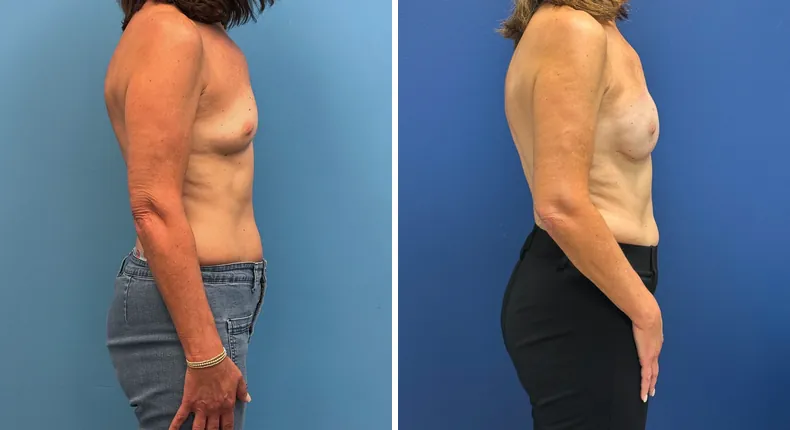 Before and after breast reconstruction: woman's breasts from the left side