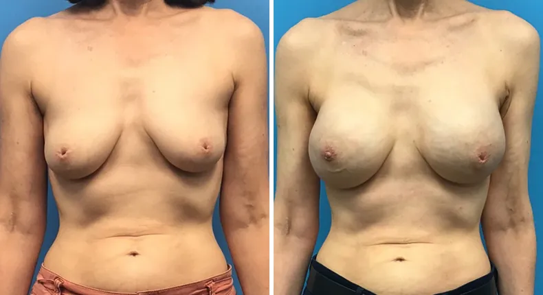 Before and after breast reconstruction: woman's breasts