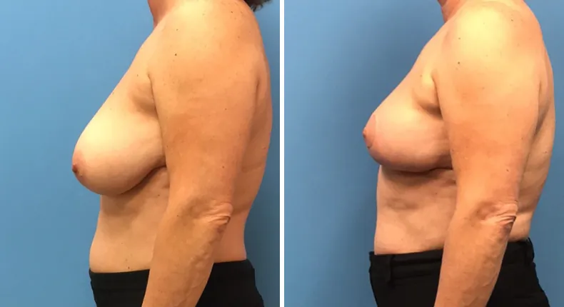 Before and after breast reconstruction: patient's breasts from the left side