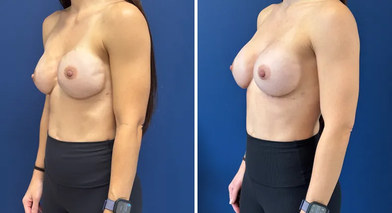 Before and after breast reconstruction: woman's breasts at a left angle