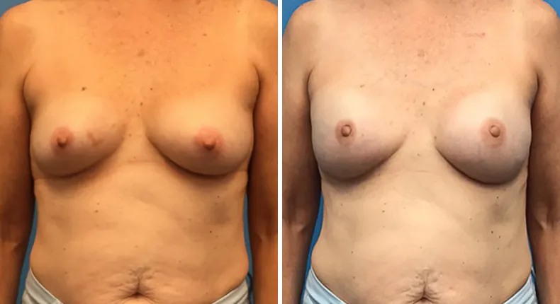 Before and after breast reconstruction: woman's breasts from the front