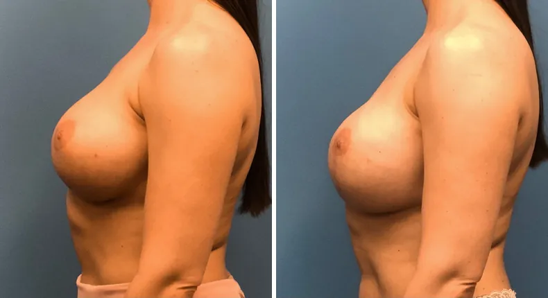 Before and after breast reconstruction: patient's breasts from the left side