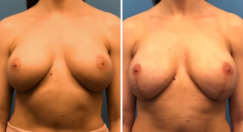 Before and after breast reconstruction: patient's breasts from the front