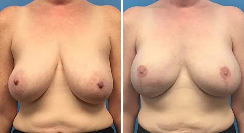 Before and after breast reconstruction: woman's breasts from the front
