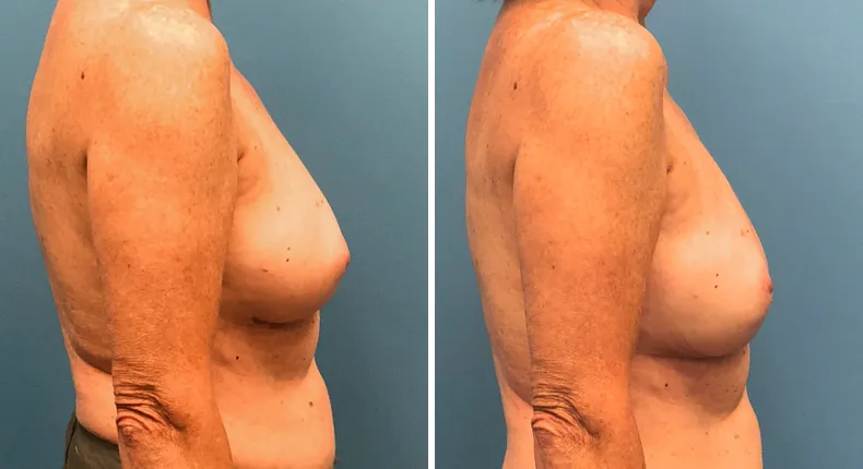 Before and after breast reconstruction: woman's breasts from the right side
