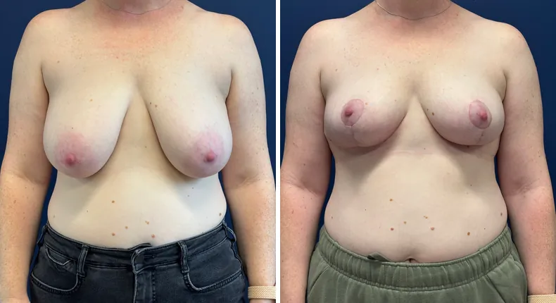 Before and after breast reconstruction: patient's breasts