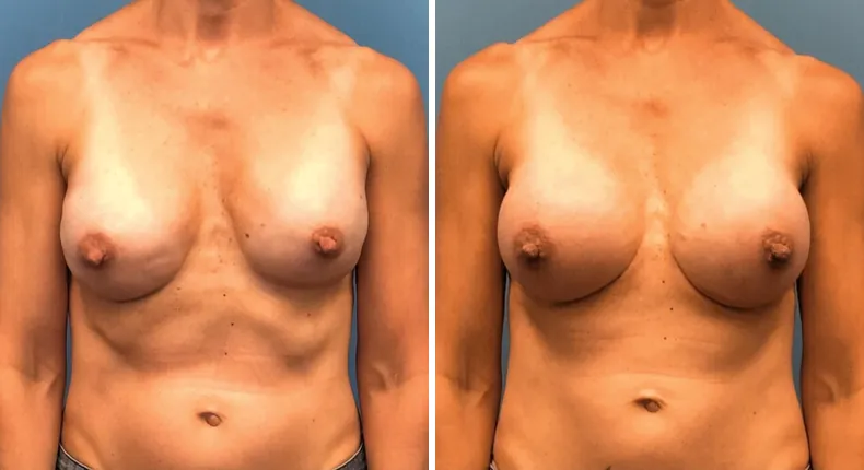Before and after breast reconstruction: patient's breasts