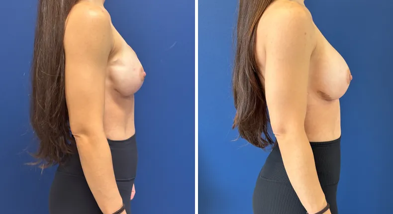 Before and after breast reconstruction: woman's breasts from the right side