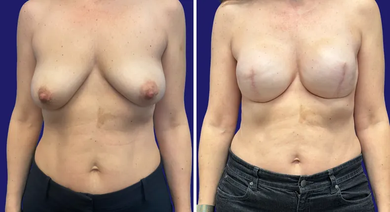 Before and after breast reconstruction: woman's breasts