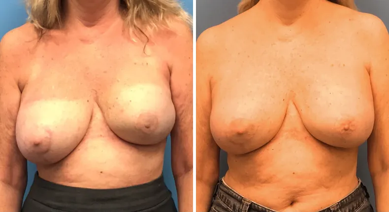 Before and after breast reconstruction: woman's breasts